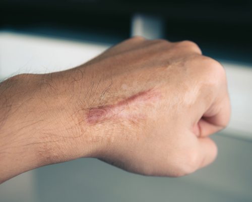 scar on human skin keloid on hand. scar on human skin keloid on hand.
